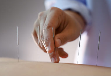 acupuncture overview